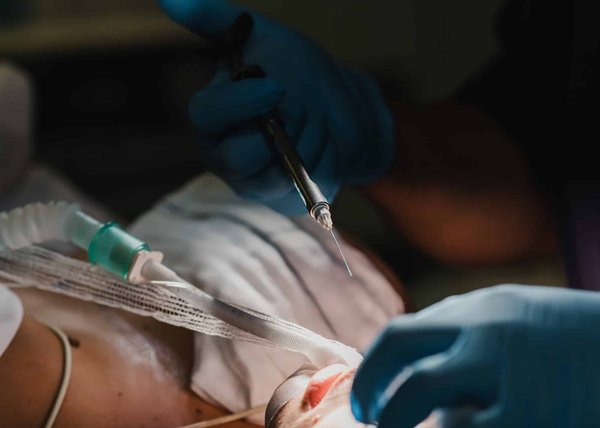 Dans quels cas faut-il recourir à la rhinoplastie ultrasonique ?